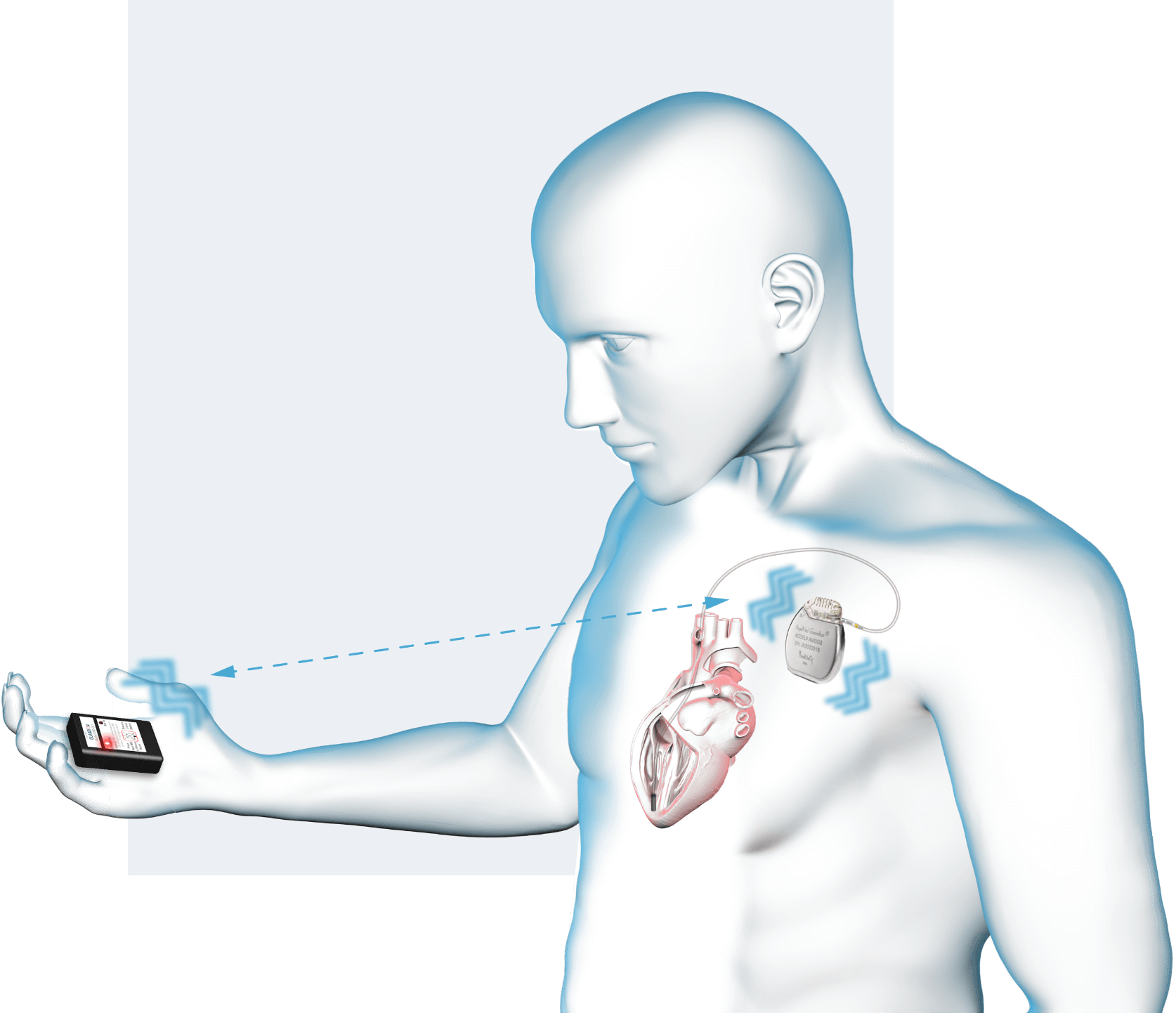 A 3D rendering of a human being with a Guardian&reg; cardiac monitor hooked up to their heart. The person is looking at a device receiving an alert from the implanted monitor. Both devices are alerting the person to a potential ACS Event.
